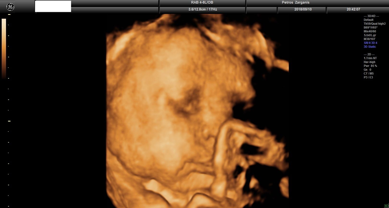Εμβρυο 36 Εβδομάδων Προγεννητική Υπερηχογραφία 3D 15